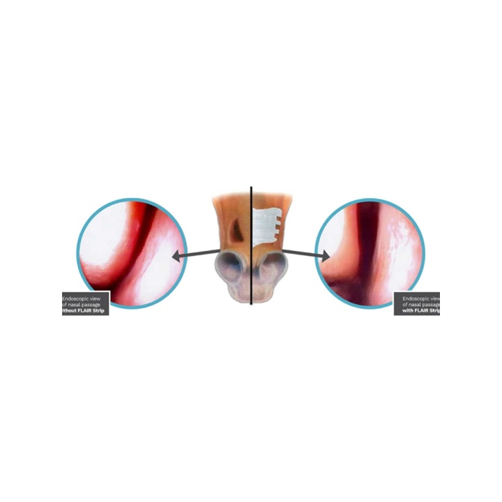 Flair Nasal Strips